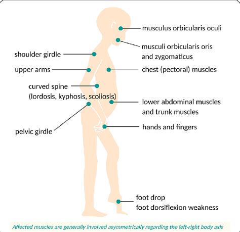 Overview of affected muscles in FSHD. The symptoms tend to start at the ...