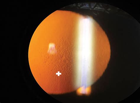 One in Five Patients Has Low-Grade Corneal Guttata Post-DMEK