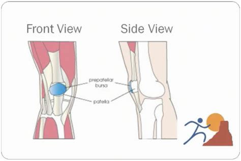 Knee Bursitis