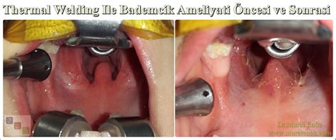 Tonsillectomy And Adenoidectomy Post Op