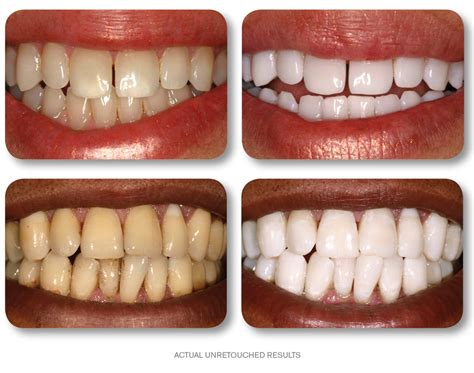 Cosmetic Teeth Whitening Before And After - TeethWalls