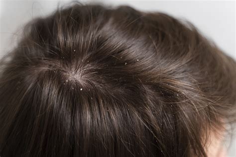 What Are PCOS Hair Growth and PCOS Hair Loss?