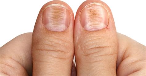 Horizontal ridges in nails-Causes, Symptoms, Treatment and Prevention