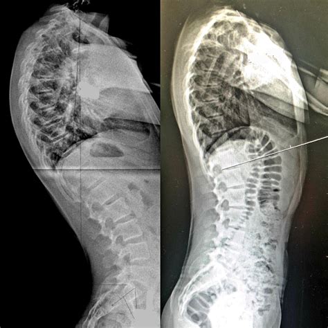 Kyphosis - Schroth method for Scheuermann's kyphosis