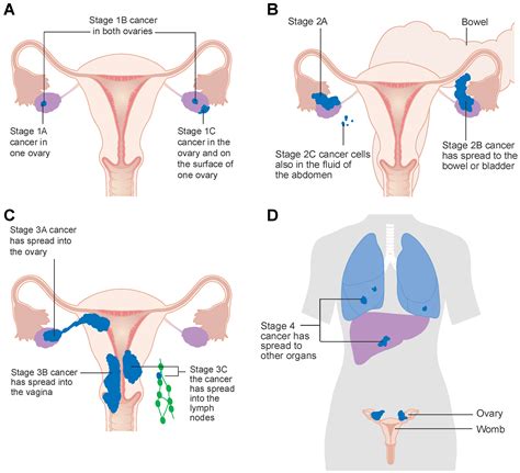 √ Stomach Stage 1 Ovarian Cancer Bloating Pictures - Cancers Free Full Text Kinase Inhibitors ...