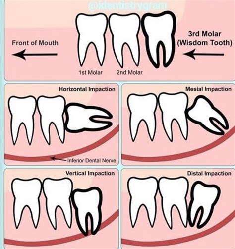 Wisdom tooth impaction Dental Hygienist, Dental Clinic, Dental Assistant Study, Impaction ...