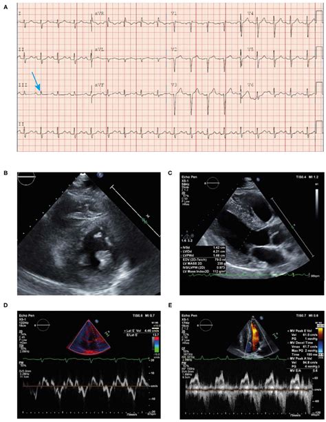 | ECG (A) showing poor R wave progression in the anterior leads and ...