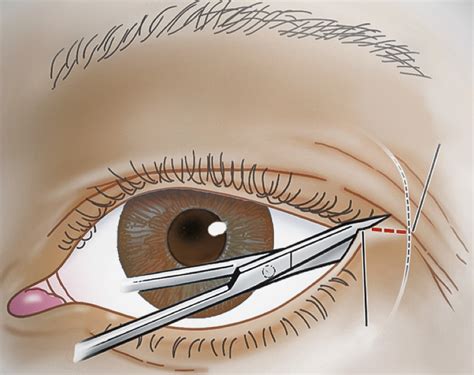 Optic nerve compression | Performing a surgical canthotomy w… | Flickr