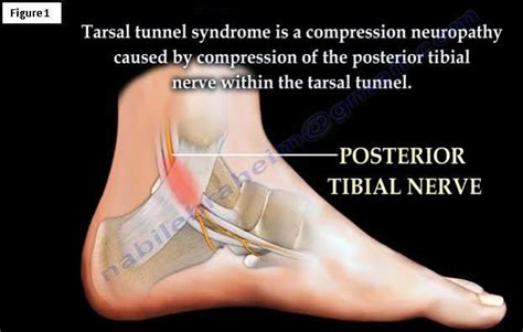 Tarsal Tunnel Syndrome - Back in Action