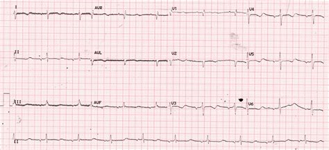 Left atrial rhythm – All About Cardiovascular System and Disorders