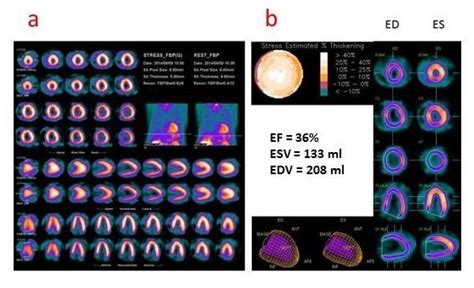 (a) Stress (exercise testing)-rest SPECT images (short, vertical and... | Download Scientific ...