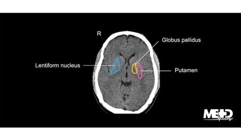 Sagittal Brain Basal Ganglia