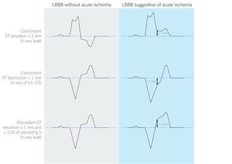 Unstable Angina Ecg