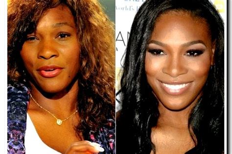 Serena Williams Before and after Plastic Surgery | Foo News