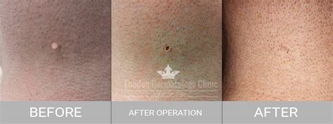 Skin Tag Removal (Same Day £159) | London Dermatology Clinic