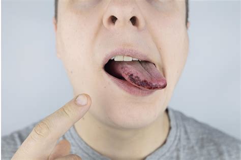 Black Spots On the Tongue: Symptoms, Causes, and Treatment