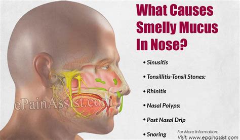 #ThroatSnoringRemedies | Mucus in throat, Dry nose, Dry throat