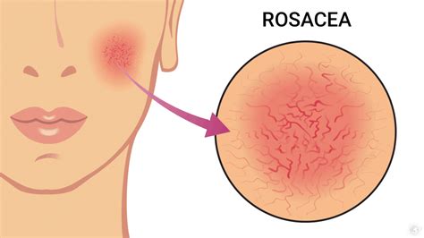 What is Acne Rosacea? Symptoms, Causes, and Treatment