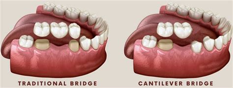 Cantilever Tooth Bridge | GM Dental | Rochester