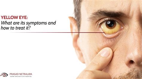 Yellow Eyes Causes And Treatment - Infoupdate.org