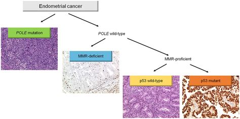 Endometrial Cancer