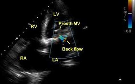 Prosthetic mitral valve echocardiogram – All About Cardiovascular System and Disorders