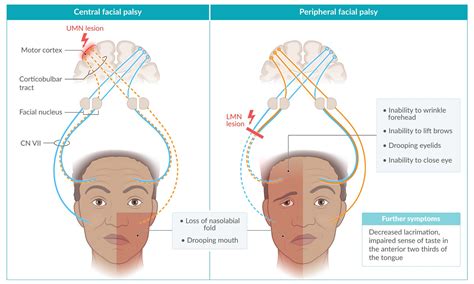 Facial Nerve Palsy Pathway