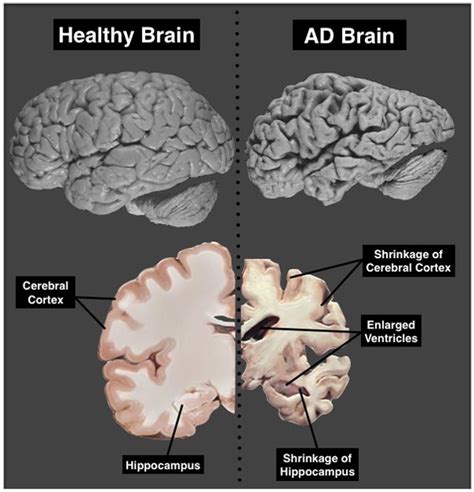 A Close Look into the Alzheimer’s Brain | Brain, Alzheimers, Brain health