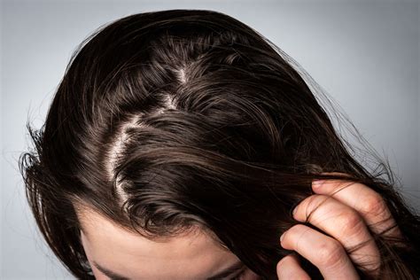 Greasy Hair: Tips to Get Rid of It Quickly