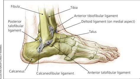 High-grade Tear Of Anterior Talofibular Ligament - lasopaaplus