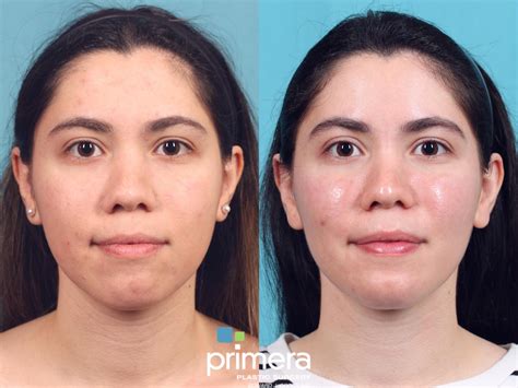 Buccal Fat Removal for Orlando & Winter Park, FL | Primera Plastic Surgery