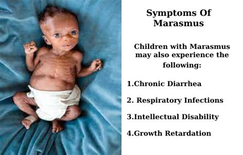 Marasmus – Symptoms, Causes, Risks, How is It Treated?