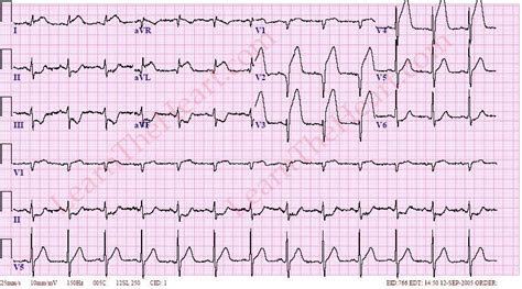 Anterior Wall ST Segment Elevation Myocardial Infarction (MI) ECG (Example 1) | Learn the Heart