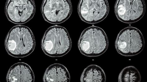 In extremely rare case, doctors remove fetus from brain of 1-year-old ...