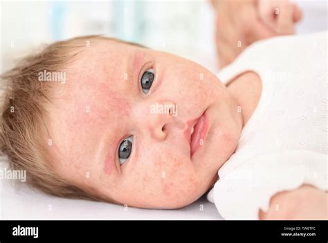 Skin Allergy High Resolution Stock Photography and Images - Alamy