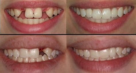 dental-implant-before-and-after - Dr George DDS