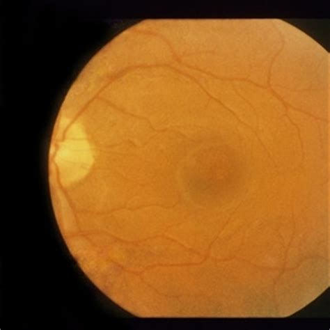 Paracentral Scotoma - Retina Image Bank