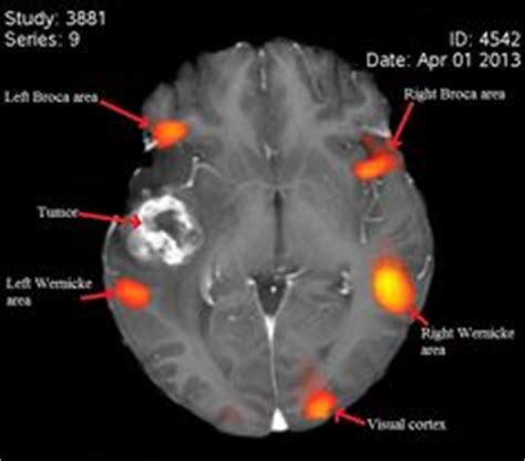 13 Best Broca's area images in 2019 | Broca's area, Brain, Neurology