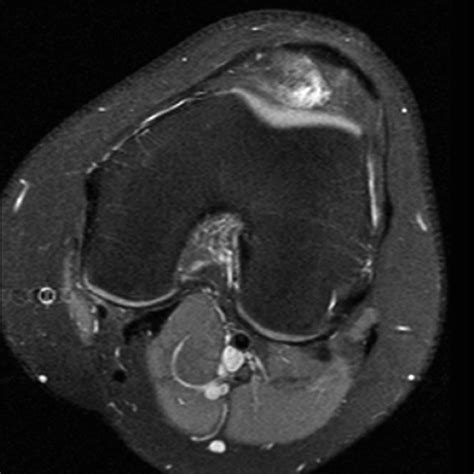 Synovial Plicae of the Knee | Radsource