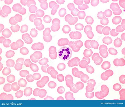 Human Blood Smear. Neutrophil Hypersegmentation Stock Image - Image of smear, hypersegmentation ...