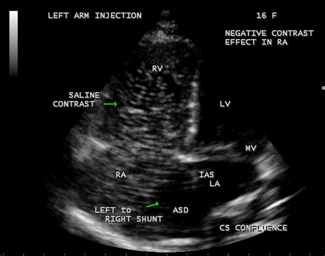 Bubble study showing the negative contrast effect in the right atrium ...