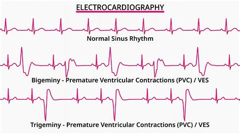 Trigeminy PVC: Definition, Causes, Treatment