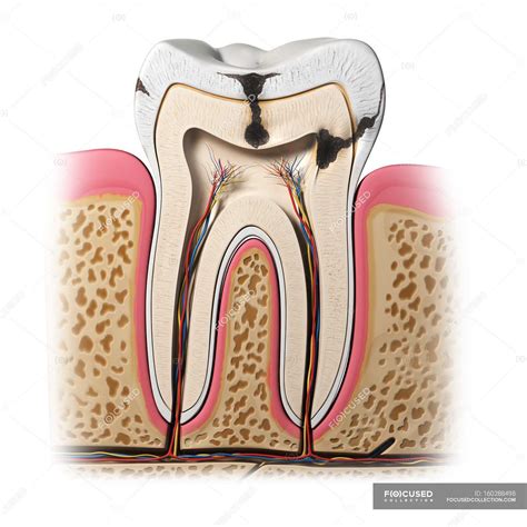 Pathology of Tooth decay — cross section, Front View - Stock Photo | #160288498