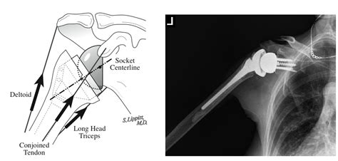 Reverse Total Shoulder or Delta Shoulder for Shoulder Arthritis Combined with Massive Rotator ...