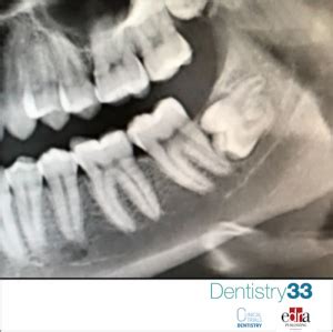 Impacted mandibular third molars: Can they cause carious lesions and periodontal disease in ...