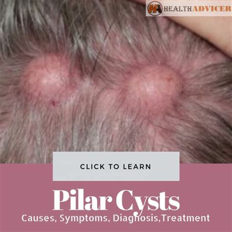 Pilar Cysts : Causes, Picture, Symptoms, And Treatment