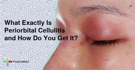 What Exactly Is Periorbital Cellulitis—and How Do You Get It?