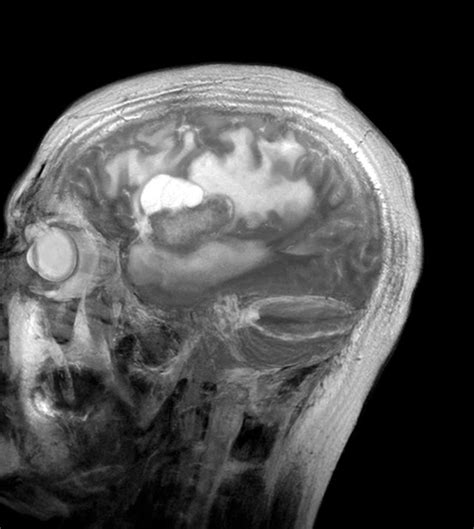 Brain Cancer, Mri Scan Photograph by Du Cane Medical Imaging Ltd - Pixels