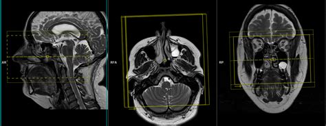 MRI Facial Nerve | Facial Nerve MRI Protocol and Planning