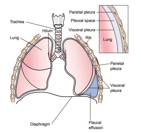 Pleural Effusion - Pleural Conditions